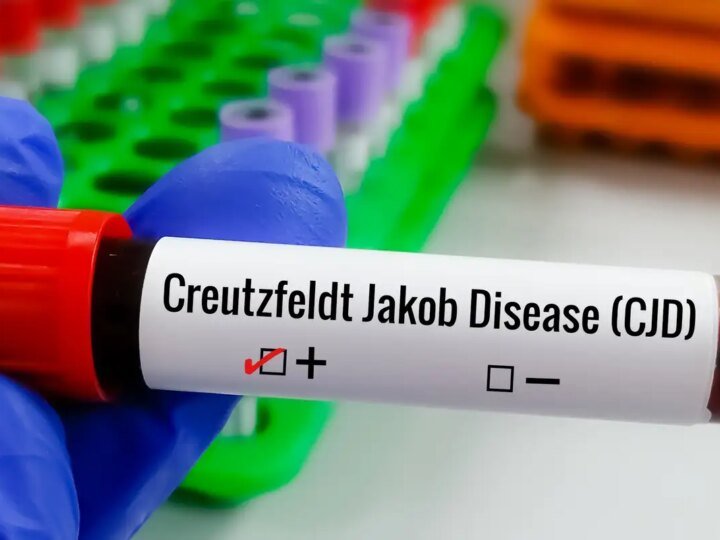 Compreendendo a Doença de Creutzfeldt-Jakob e a Busca por Tratamentos Eficazes