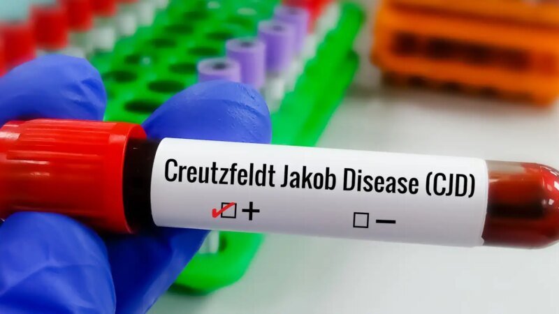 Compreendendo a Doença de Creutzfeldt-Jakob e a Busca por Tratamentos Eficazes