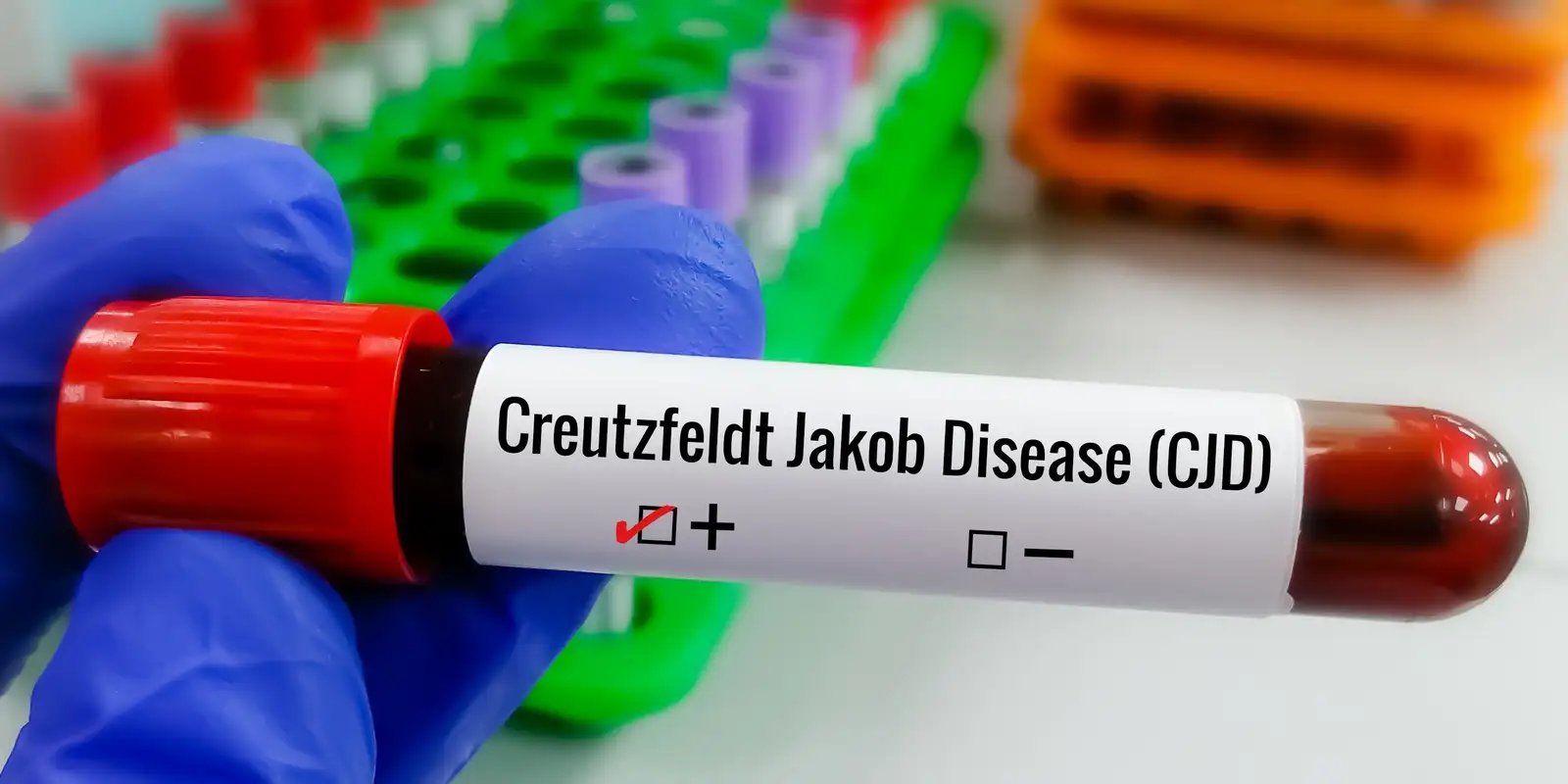 Compreendendo a Doença de Creutzfeldt-Jakob e a Busca por Tratamentos Eficazes