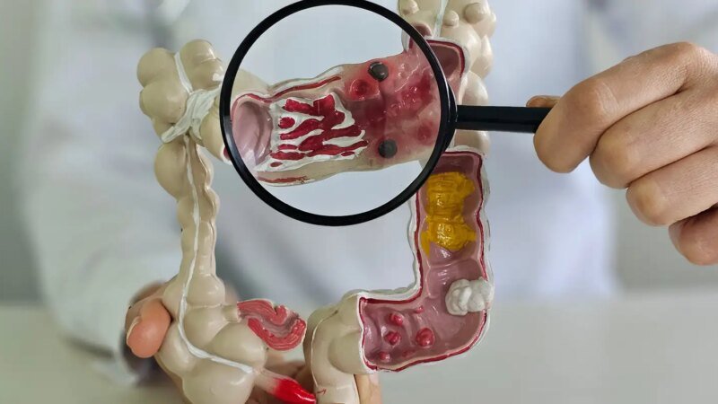 Crescimento alarmante das doenças inflamatórias intestinais no Brasil