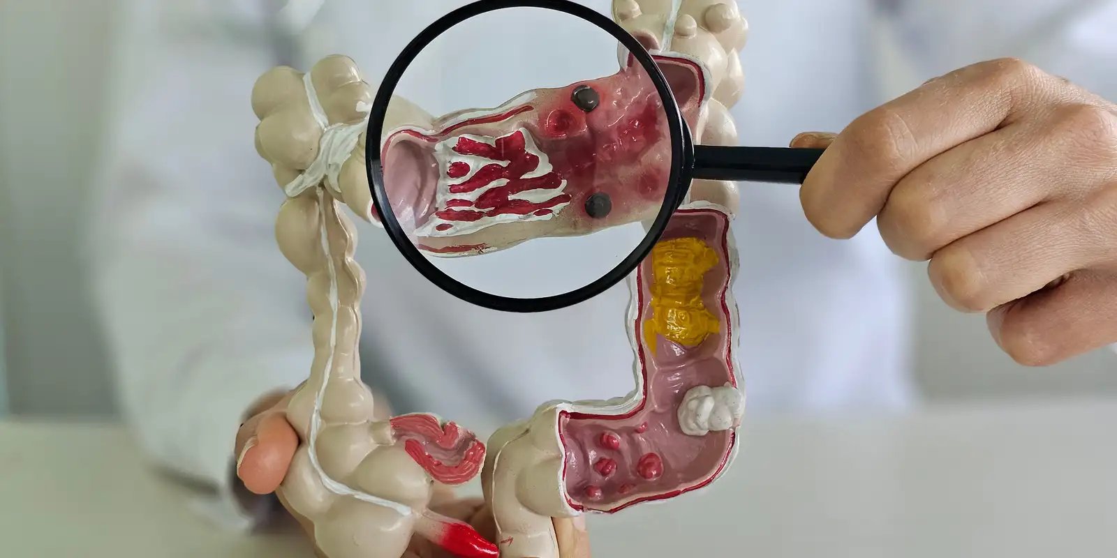 Crescimento alarmante das doenças inflamatórias intestinais no Brasil