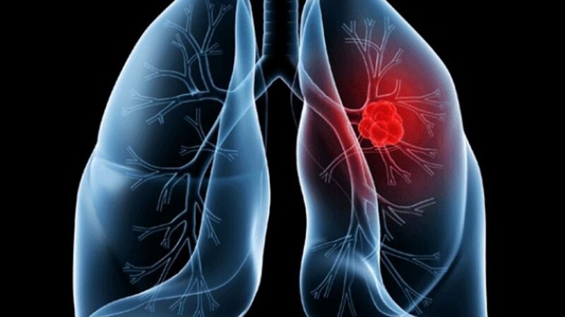 Adenocarcinoma Pulmonar: Compreendendo o Câncer que Afeta o Papa