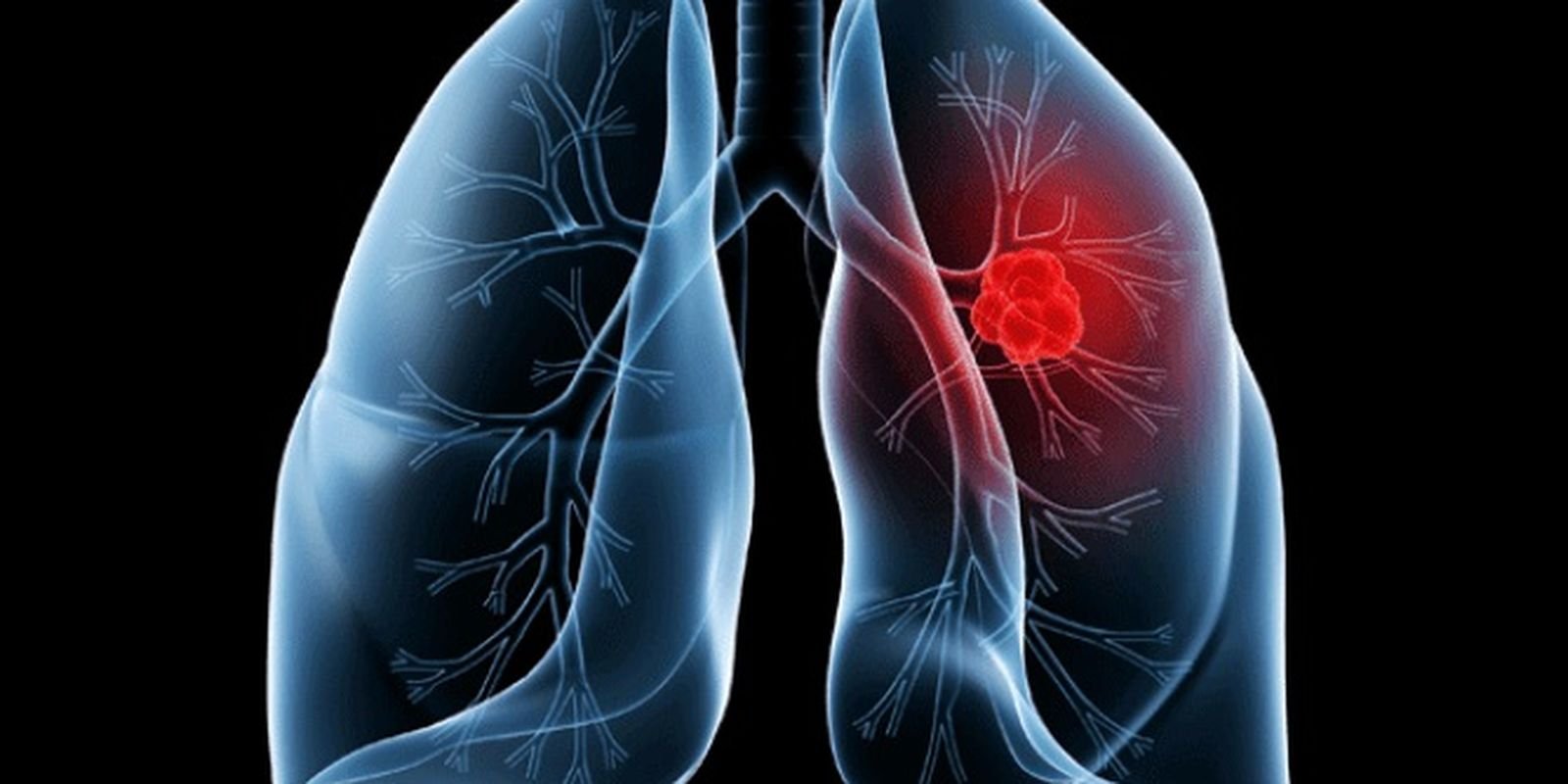 Adenocarcinoma Pulmonar: Compreendendo o Câncer que Afeta o Papa